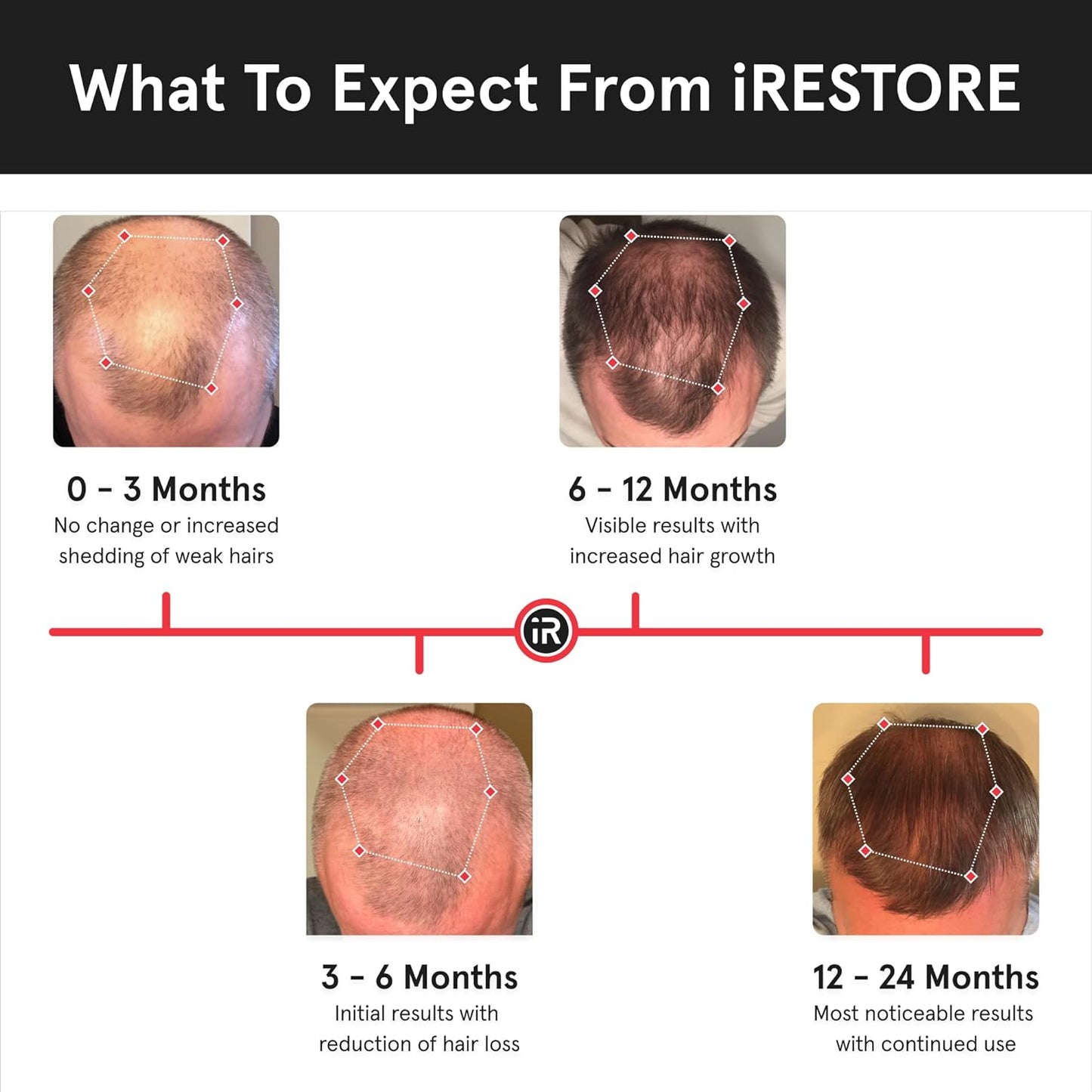 iRestore Essential - Laser Red Light Therapy for Hair Growth - FDA Cleared Hair Loss, Hair Thinning & Alopecia Treatment for Men & Women